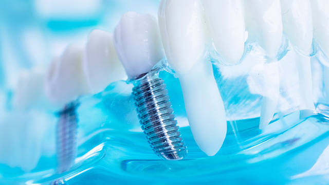 Implants Dentist Norwood MA